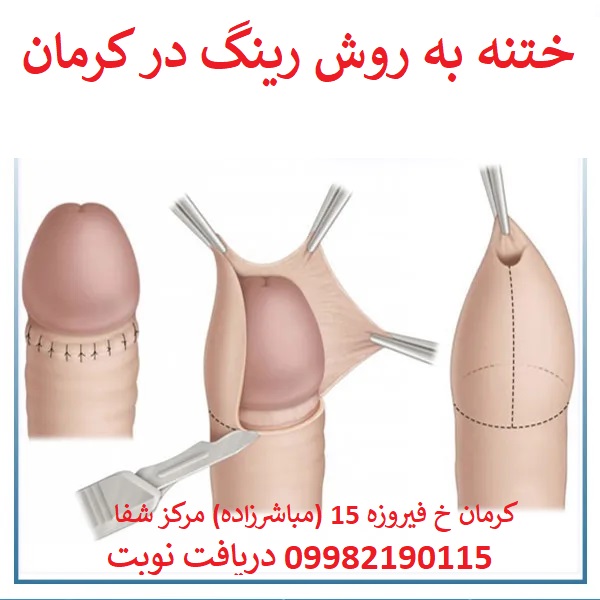 (کلیک کنید) ختنه در کرمان | ختنه به روش رینگ در کرمان